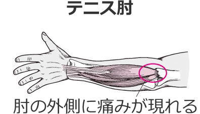 テニス肘