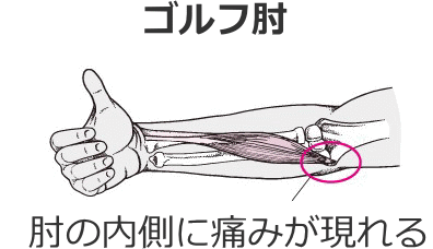 ゴルフ肘
