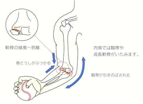 野球肘