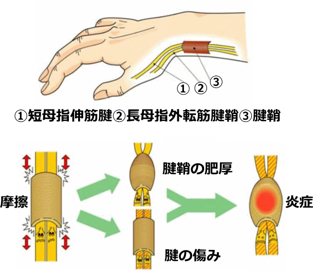 腱鞘炎の発症過程
