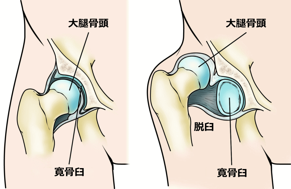 変形性股関節症の原因の一つ、先天性股関節脱臼