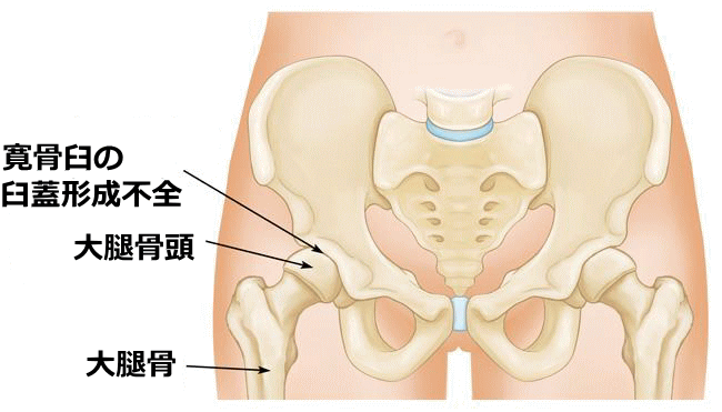 変形性股関節症の原因の一つ、臼蓋形成不全