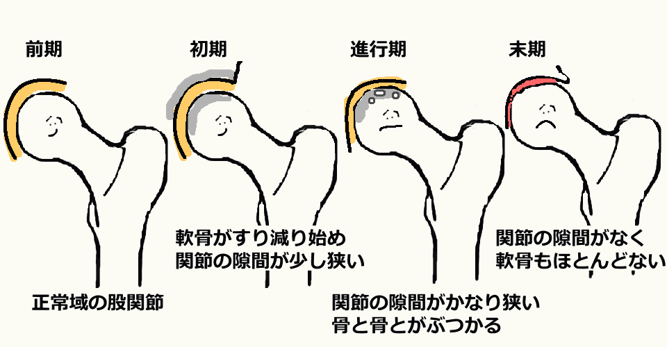 変形性股関節症の進行ステージ
