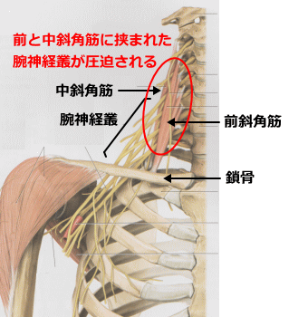 斜角筋症候群の神経圧迫箇所