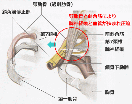頸肋症候群の神経圧迫箇所