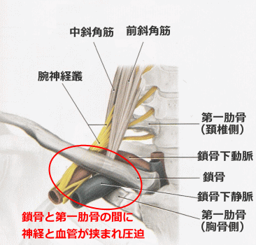 肋鎖症候群の神経圧迫箇所