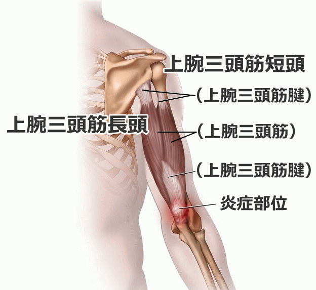 三頭筋腱炎の上腕周辺の筋肉