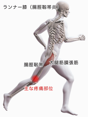 ランナー膝・腸脛靭帯炎の患部