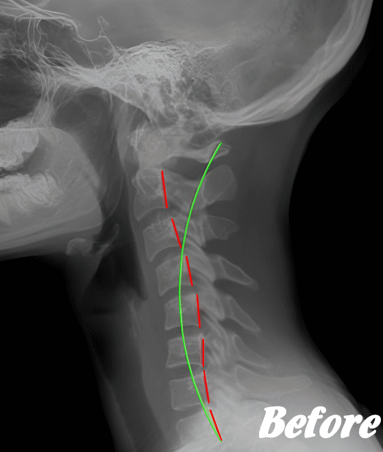 施術前の胸椎X-ray
