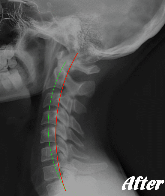 施術後の胸椎X-ray