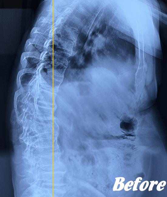 施術前の頸椎X-ray