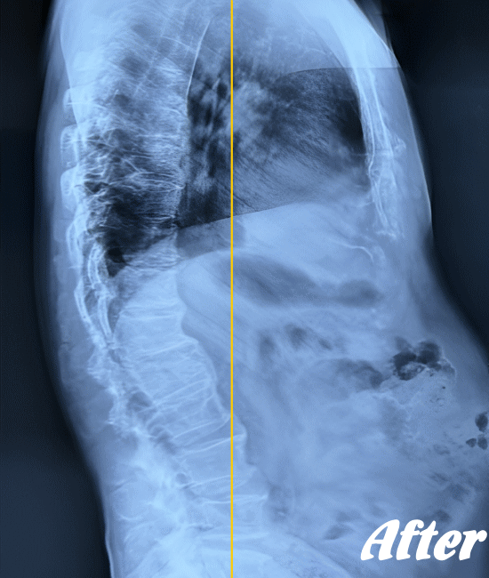 施術後の頸椎X-ray