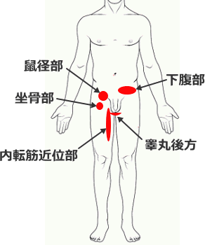 鼠径部痛症候群の発生個所