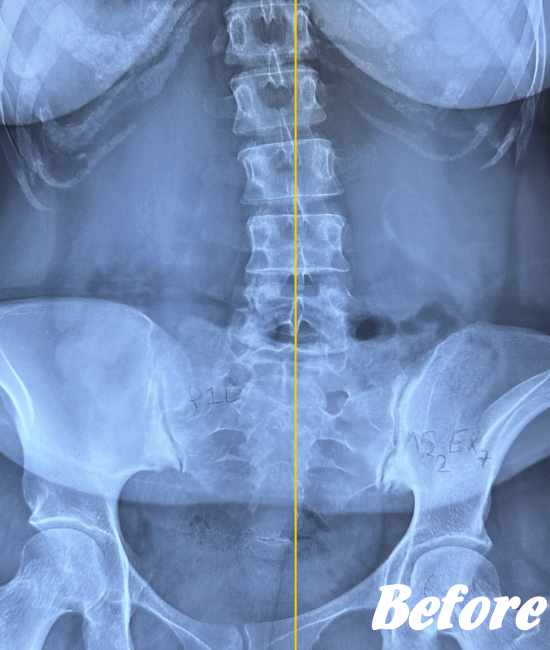 施術前のぎっくり腰の状態２