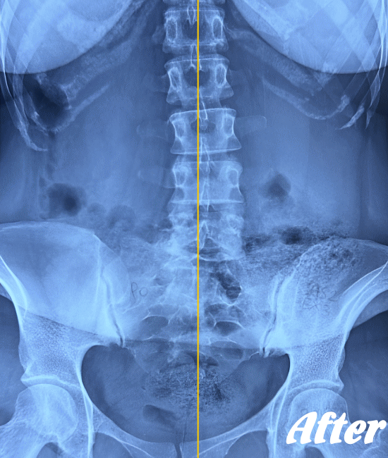 施術後のぎっくり腰の状態２