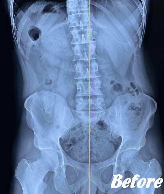 施術前のぎっくり腰の状態３