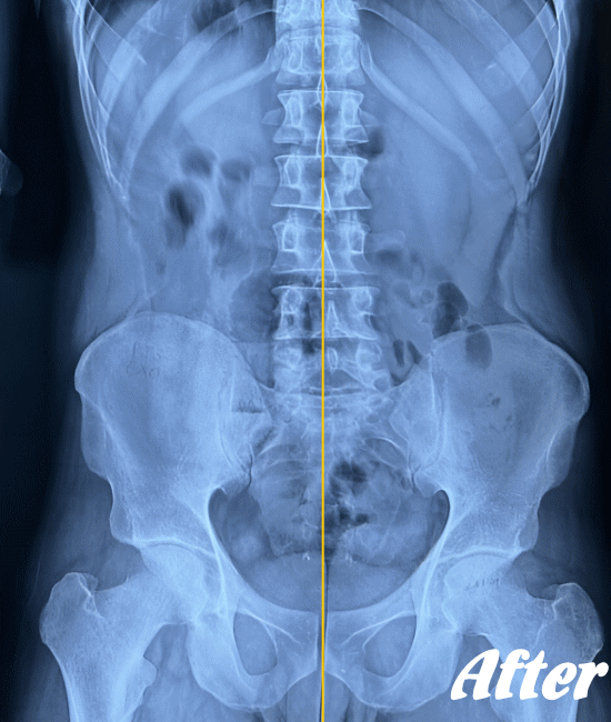 施術後のぎっくり腰の状態３