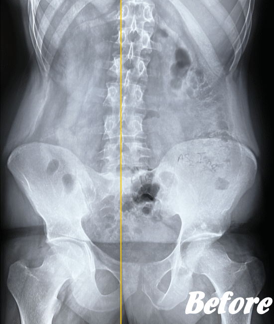 施術前のぎっくり腰の状態１