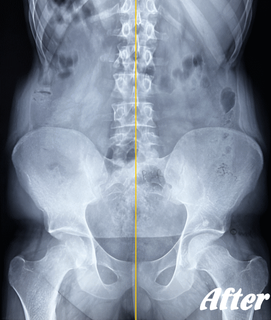 施術後のぎっくり腰の状態１