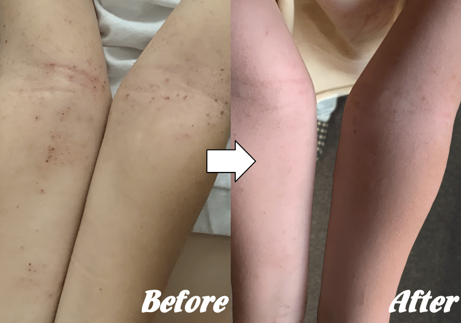 アトピー性皮膚炎の改善例３