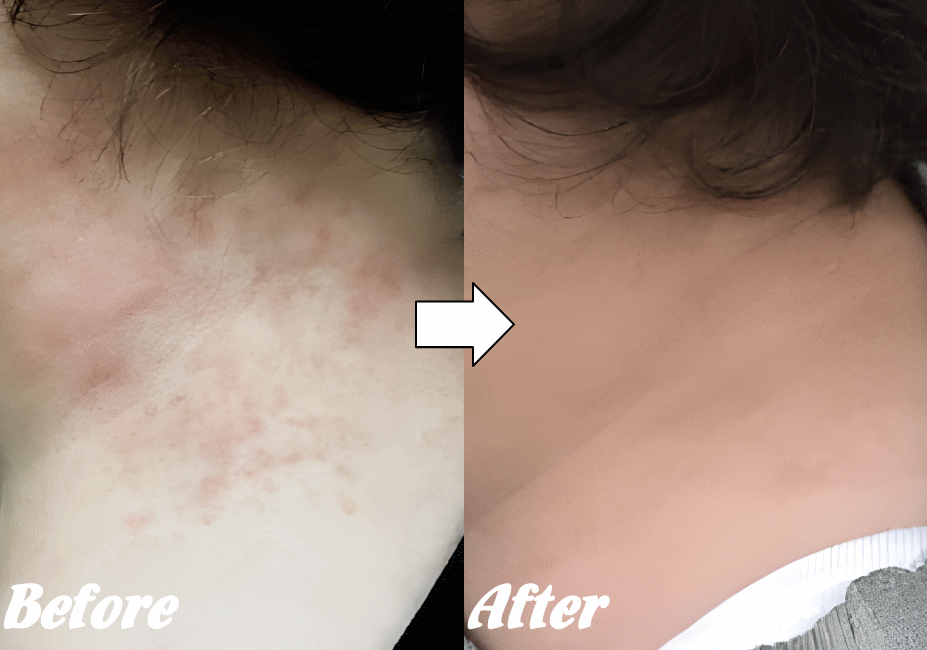 アトピー性皮膚炎の改善例７