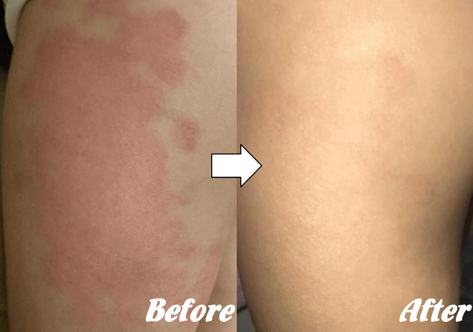 アトピー性皮膚炎の改善例８