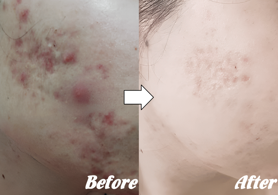 アトピー性皮膚炎の改善例４