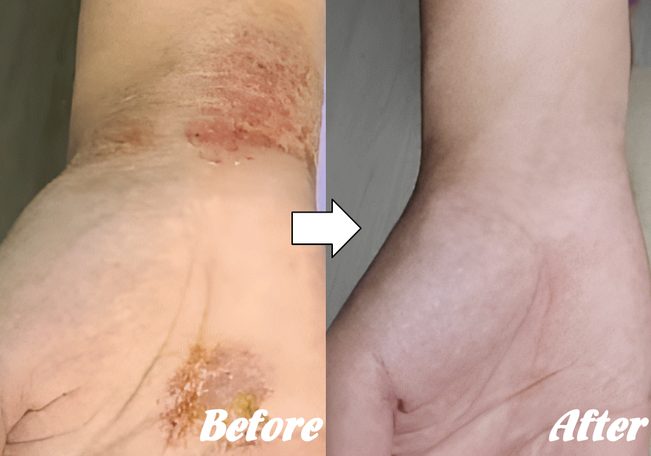 アトピー性皮膚炎の改善例６