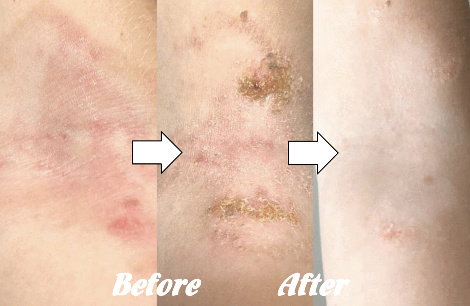 アトピー性皮膚炎の改善例５