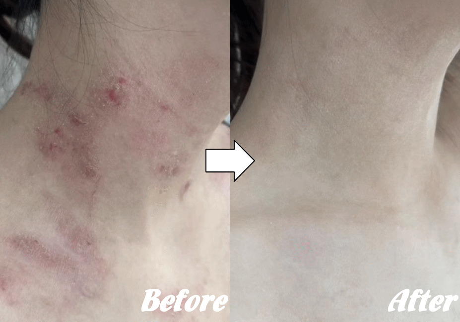 アトピー性皮膚炎の改善例１