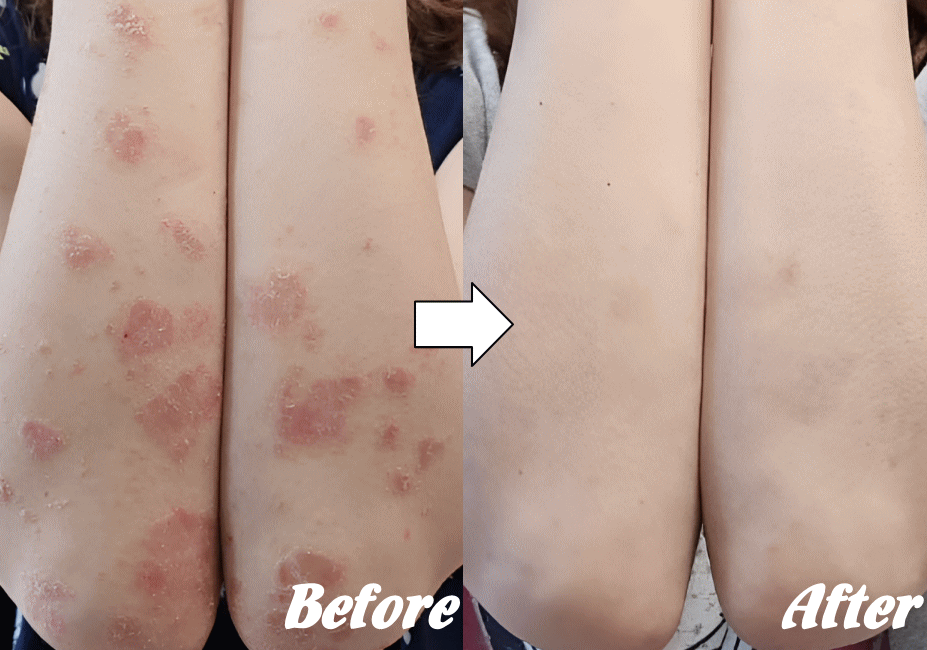 アトピー性皮膚炎の改善例２