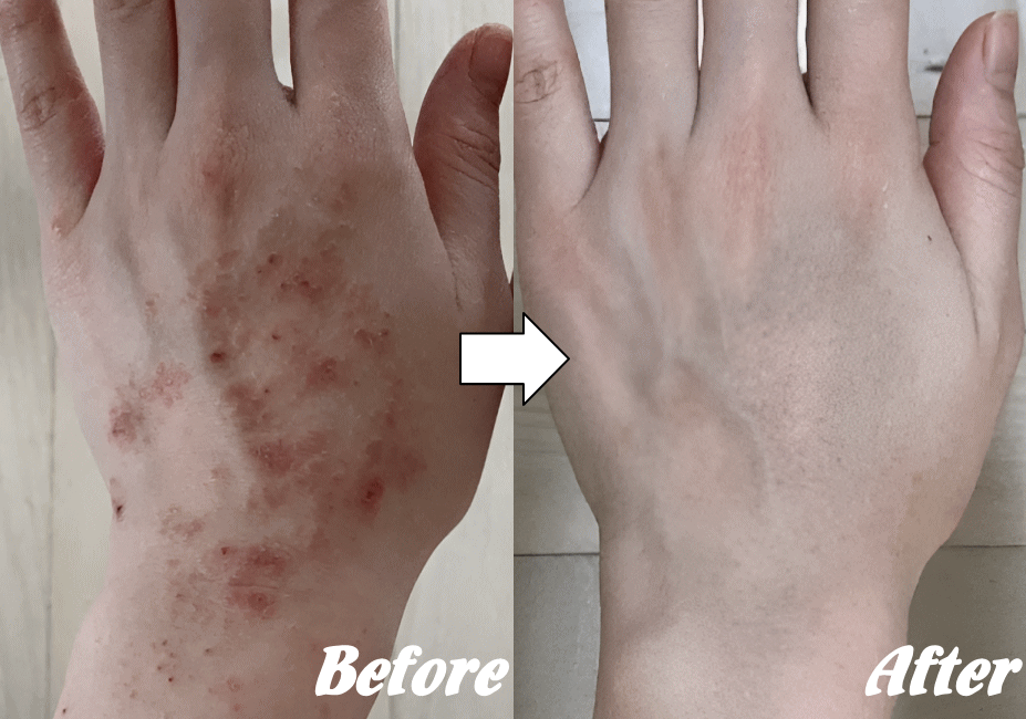 アトピー性皮膚炎の改善例９