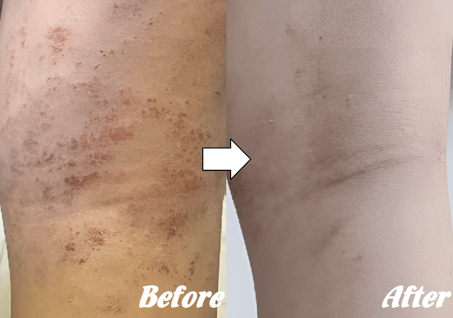 アトピー性皮膚炎の改善例１０