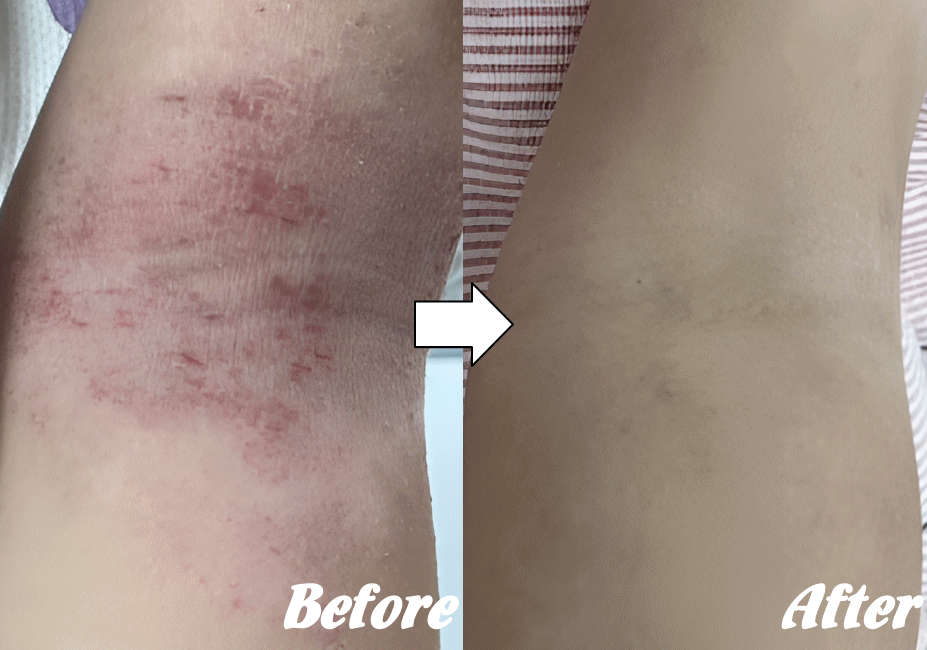 アトピー性皮膚炎の改善例１１