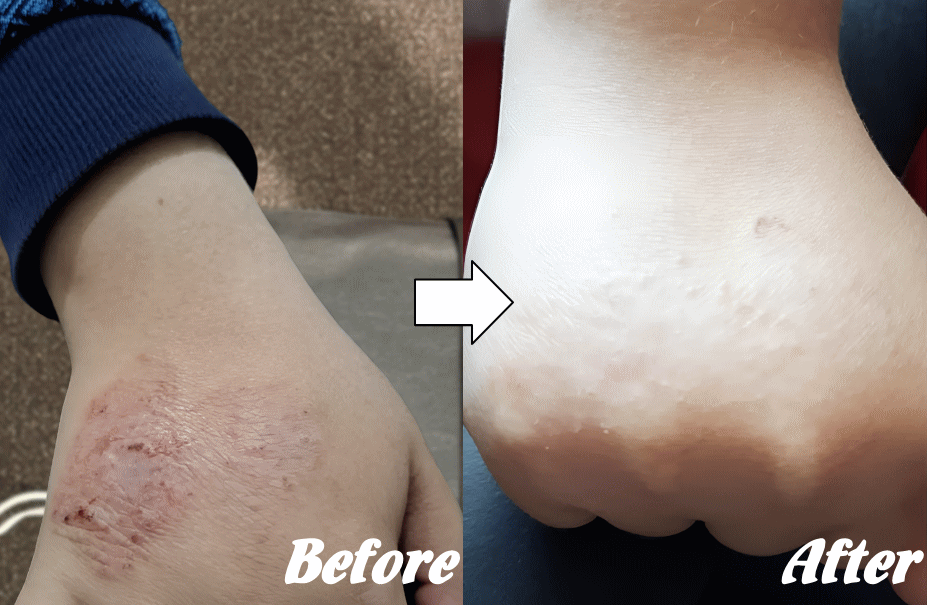 アトピー性皮膚炎の改善例１２