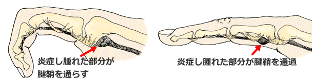 曲がったまま伸びないバネ指(弾発指)