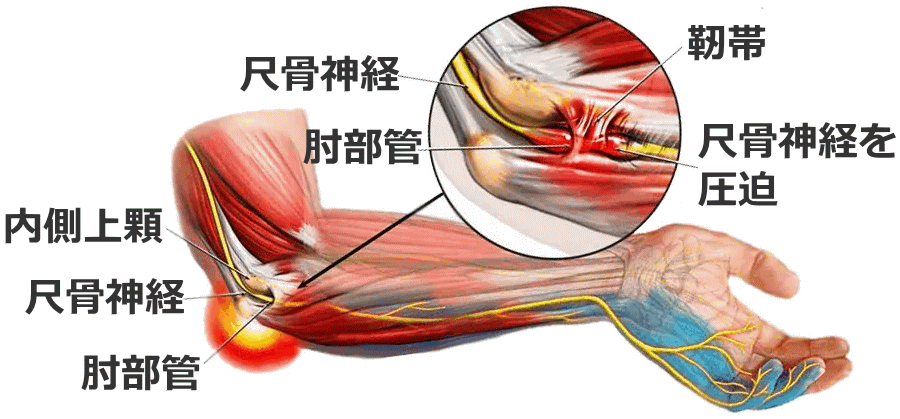 肘部管症候群の発生ポイント