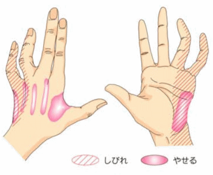 肘部管症候群による症状