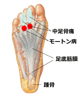 中足骨痛・モートン病の発生個所