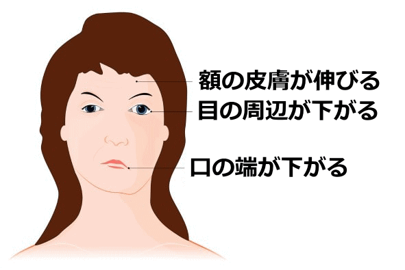 顔面神経麻痺の主な症状