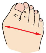 靭帯性外反母趾