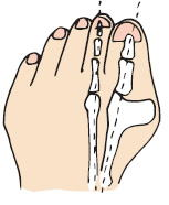 仮骨性外反母趾