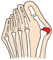 混合性外反母趾