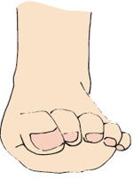 ハンマートウ性外反母趾