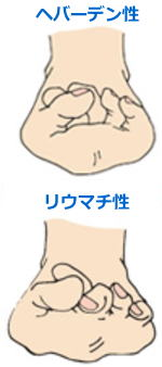 病変性外反母趾