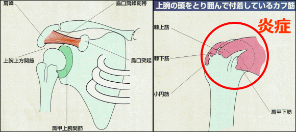 烏口肩峰靭帯とカフ筋