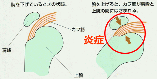 関節によるカフ筋の圧迫