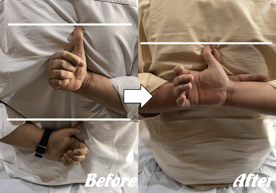 五十肩の施術の変化2