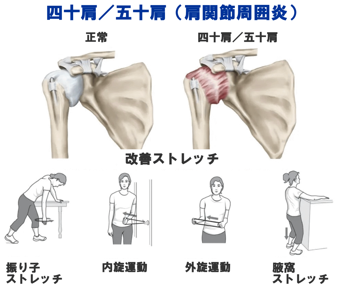 四十肩・五十肩の改善ストレッチ