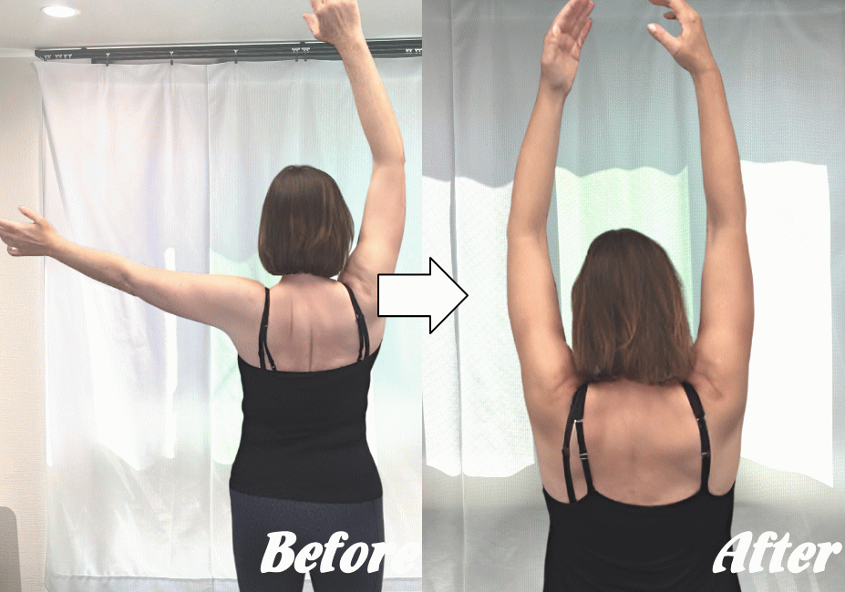 五十肩の施術の変化1